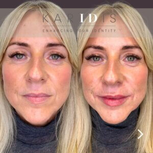 Lip filler for anti-ageing