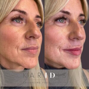 Lip filler to reverse ageing