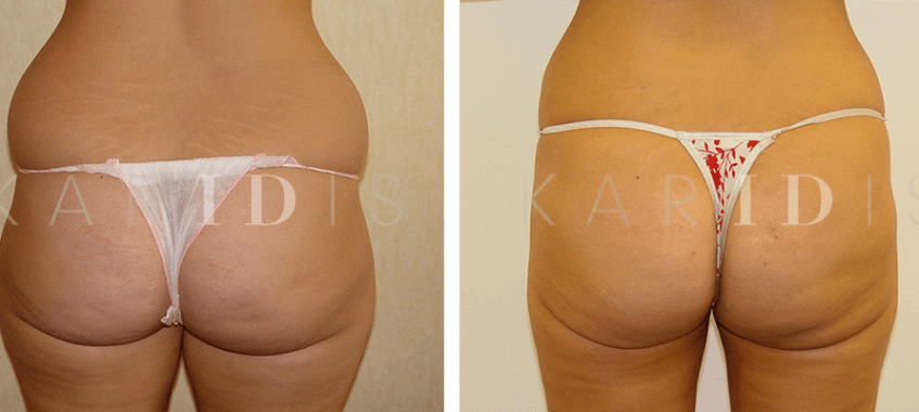 Liposuction for muffin top results