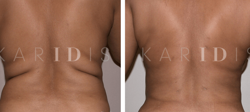 Liposuction results at six weeks