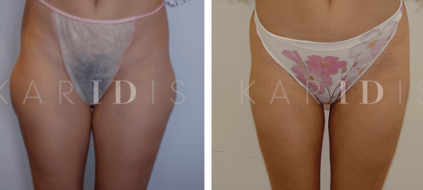 Liposuction to saddlebags results