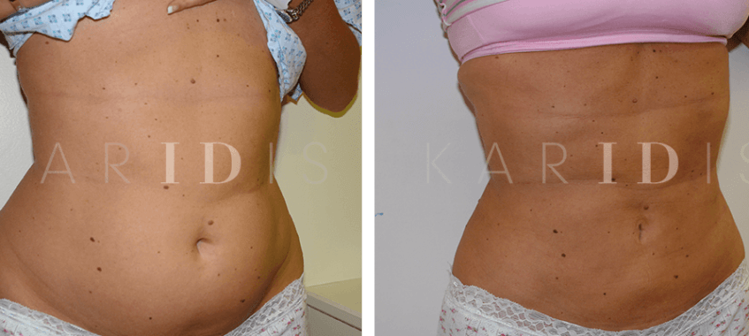 Liposuction to the abdomen before and afters