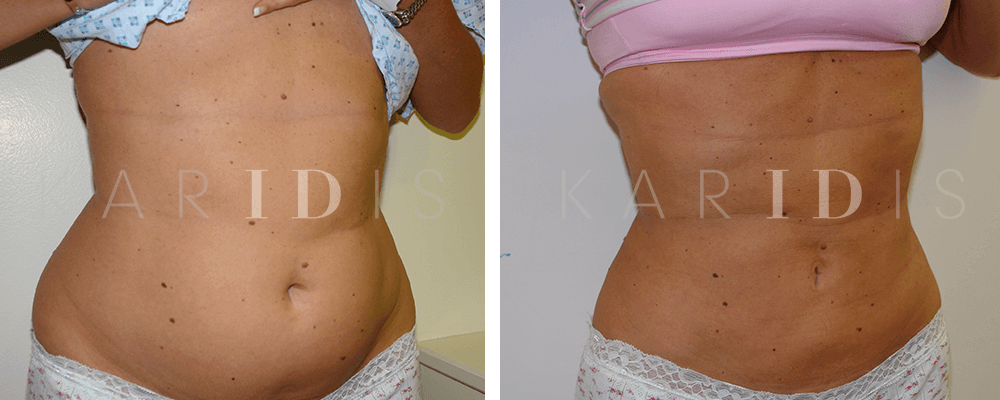 Obese Liposuction Before And After  Before And After