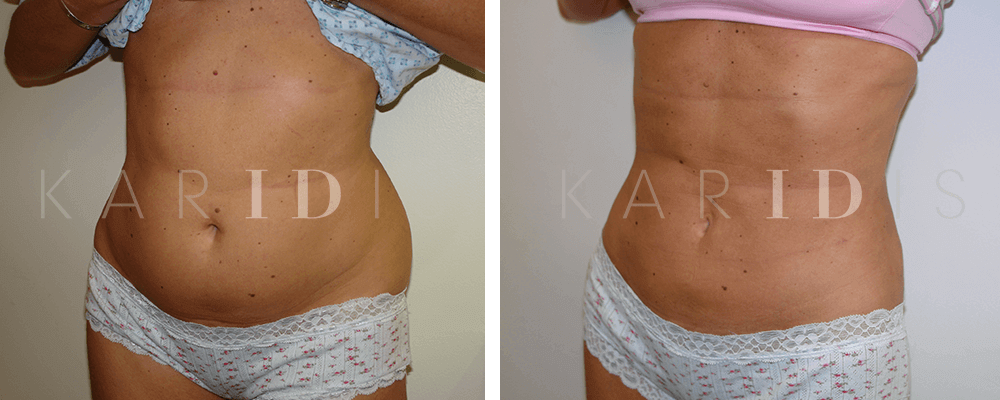 Fat Removal Surgery (Liposuction) Before and After Photos UK | Karidis