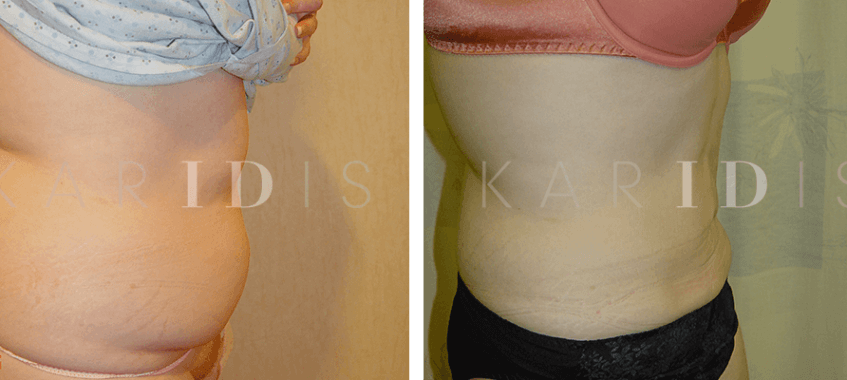 Liposuction to the abdomen results