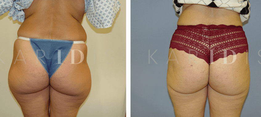 Liposuction to the outer thighs before and afters