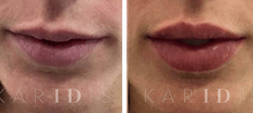 London Lip Augmentation with Fillers