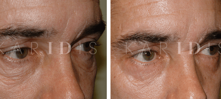 Male Blepharoplasty Before and Afters