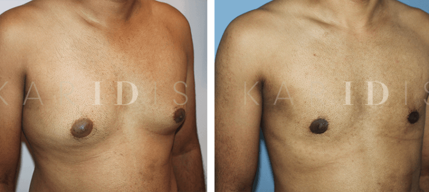Male Breast Reduction Before and Afters