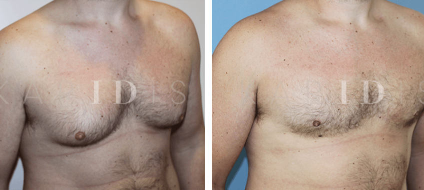 Male Breast Reduction Results