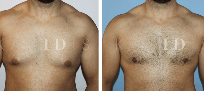 Male Chest Reduction Surgery Results