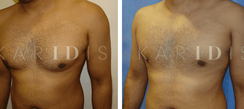 Male Chest Reduction Surgery Results