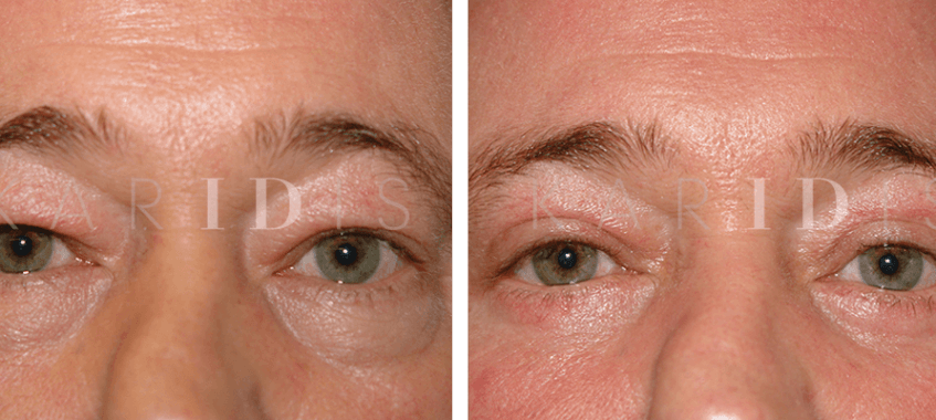 Male Eyelid Lift Results