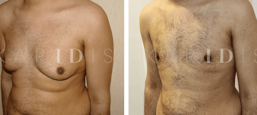 Male breast reduction before and afters