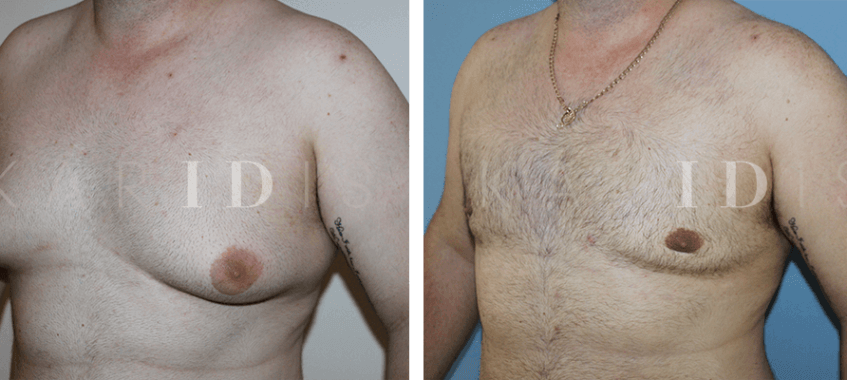 Male breast reduction results