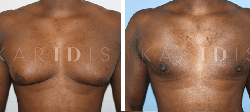 Male chest reduction surgery before and afters