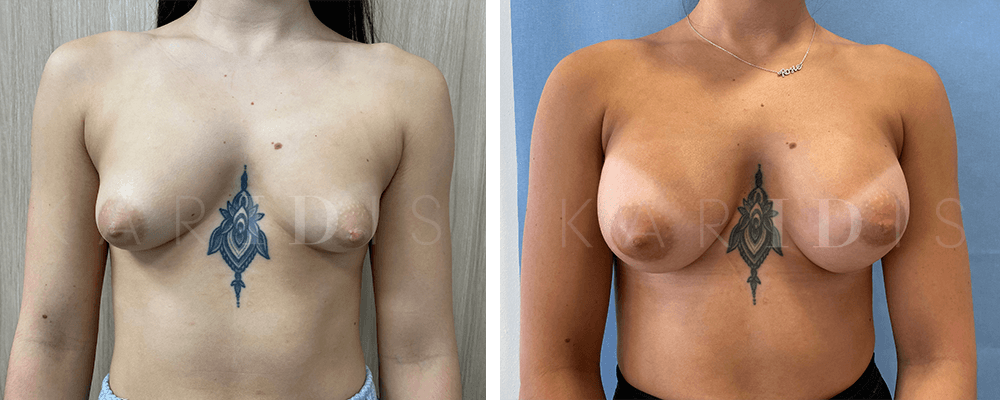 Breast Augmentation Before and Afters