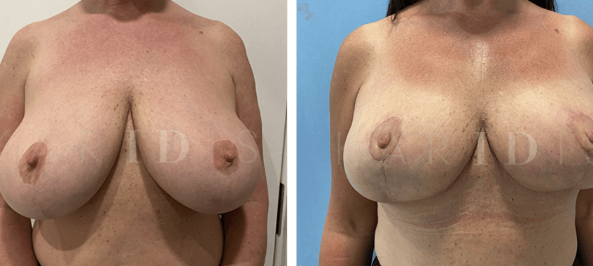 Breast Reduction Before and Afters