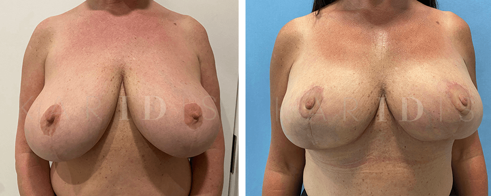 Breast Reduction Before and Afters