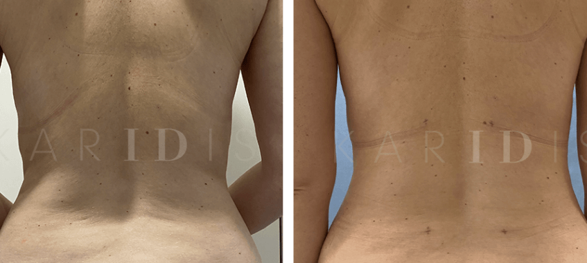 Liposuction Before and Afters