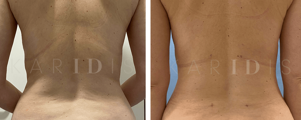 Liposuction Before and Afters