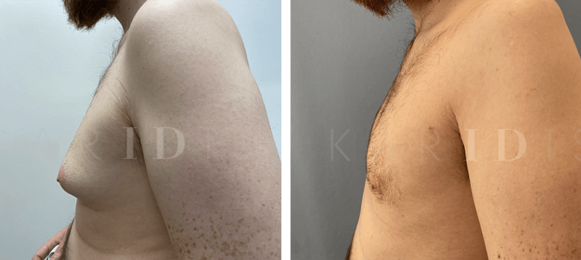 Male Chest Reduction Before and Afters