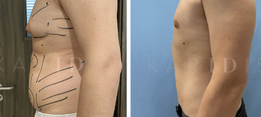 Male Chest Reduction Before and Afters