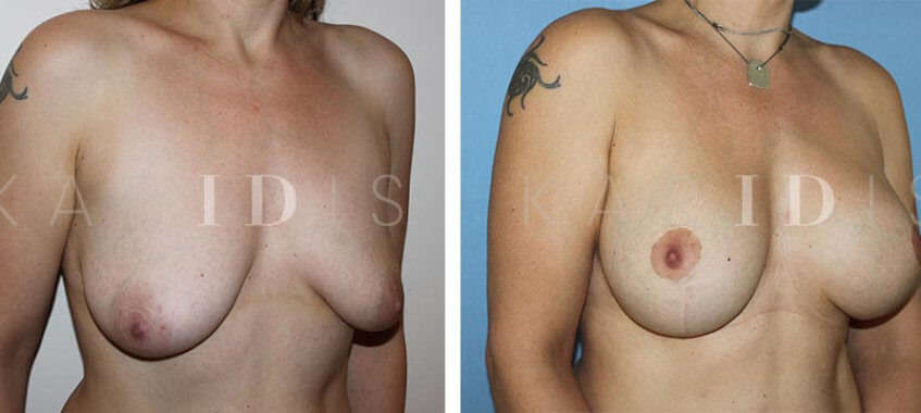Mastopexy augmentation before and afters