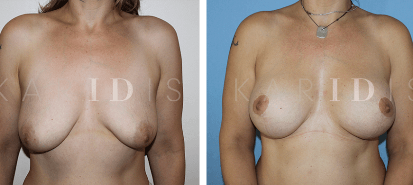 Mastopexy augmentation results