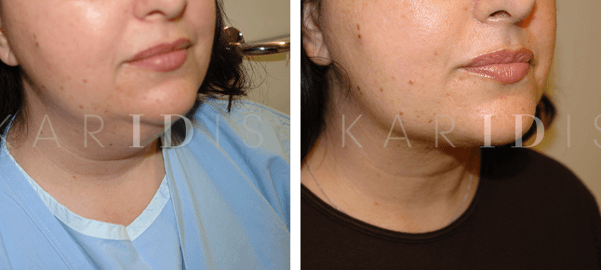Neck liposuction before and afters