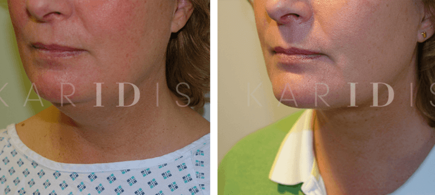 Neck liposuction results