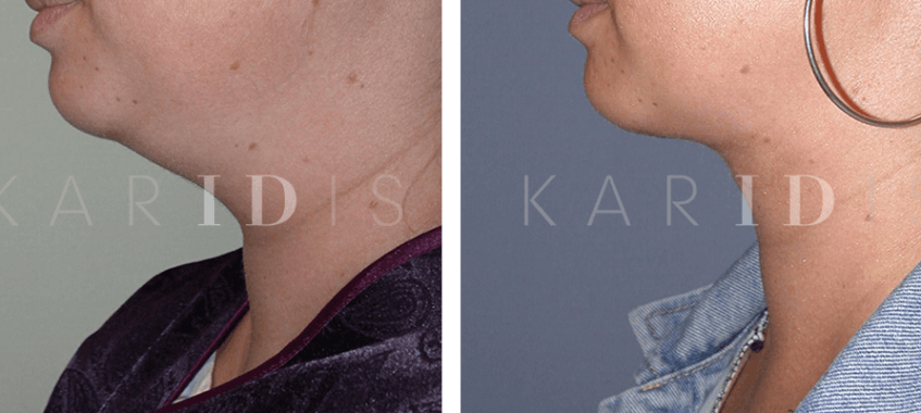 Neck liposuction results