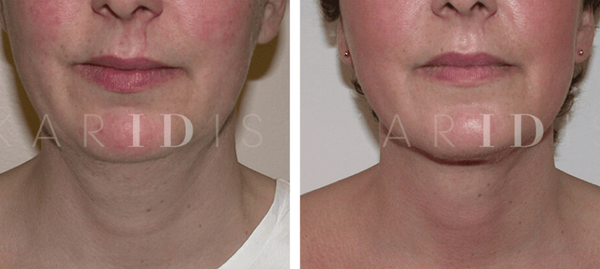 Neck reshaping with lipo