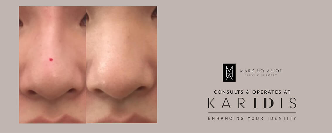 Nose Reshaping by Mr Mark Ho-Asjoe at Karidis Clinic