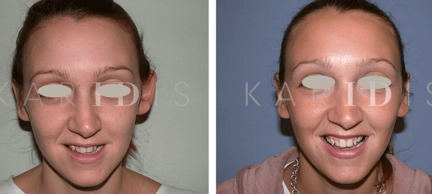 Otoplasty Before and Afters