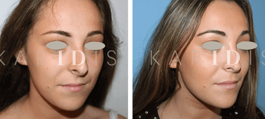 Rhinoplasty before and afters