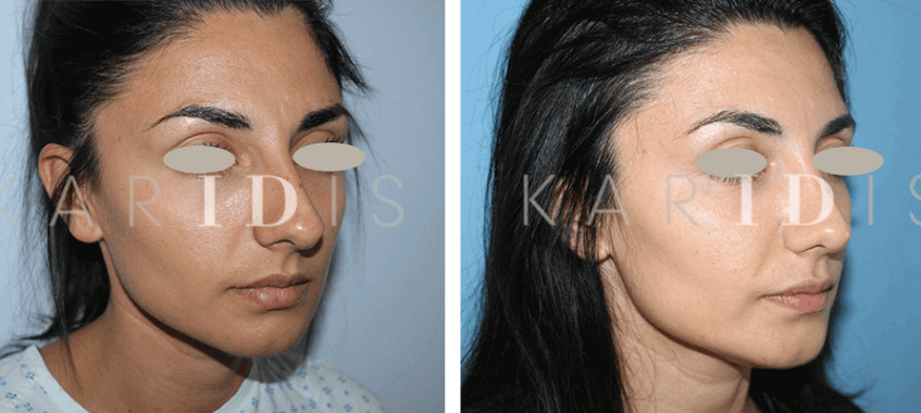 Rhinoplasty before and afters