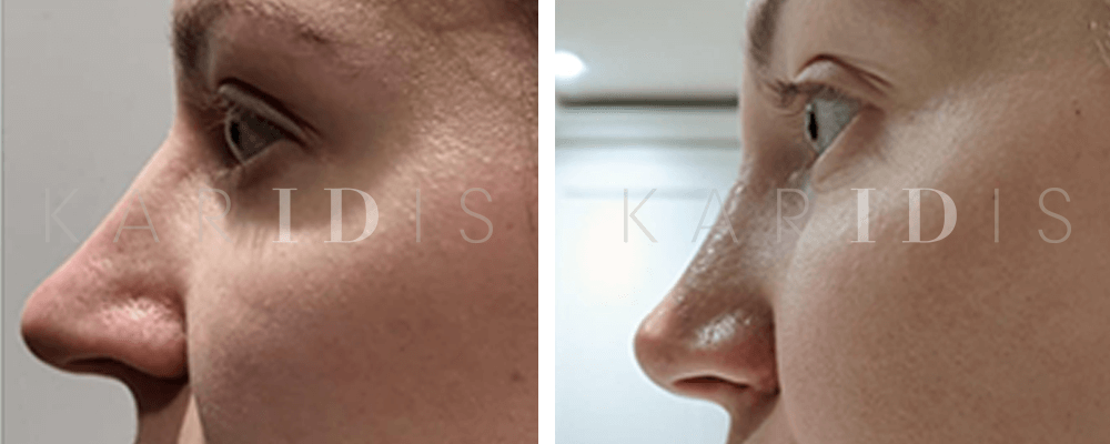 Rhinoplasty Before and Afters