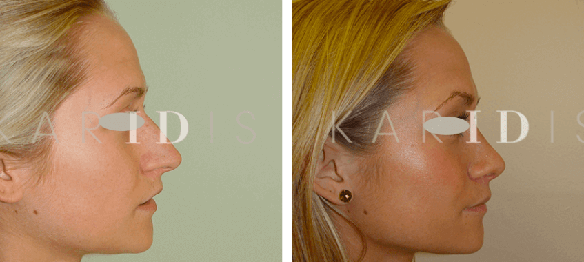 Rhinoplasty Before and Afters