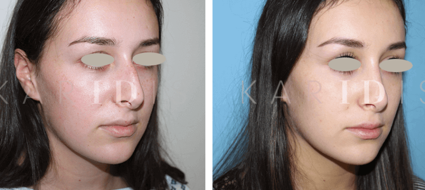 Rhinoplasty Before and Afters