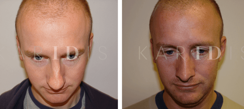 Rhinoplasty Before and Afters