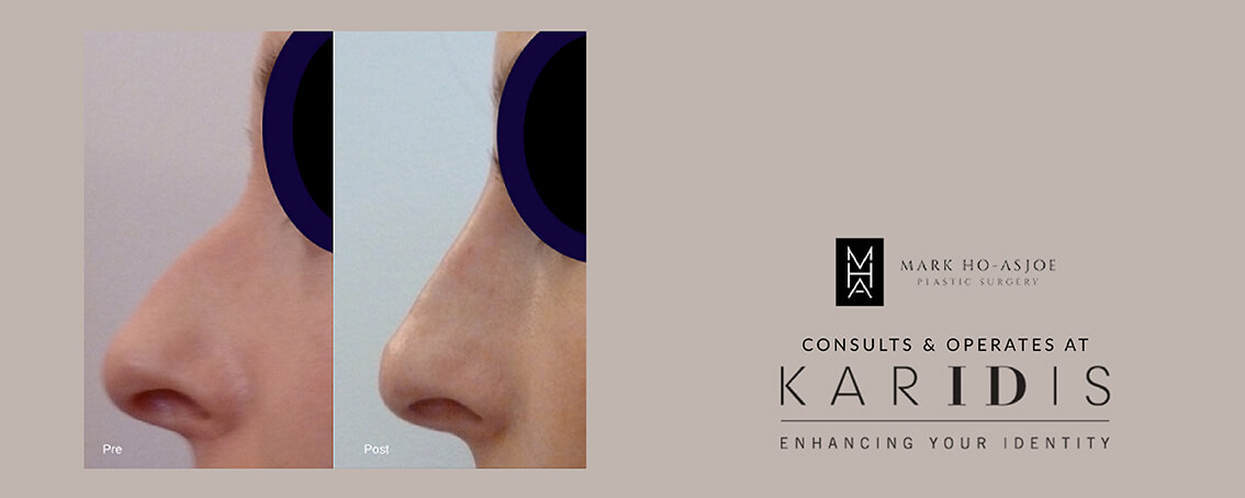 Rhinoplasty by Mr Mark Ho-Asjoe at Karidis Clinic