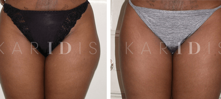Thigh lipo before and afters