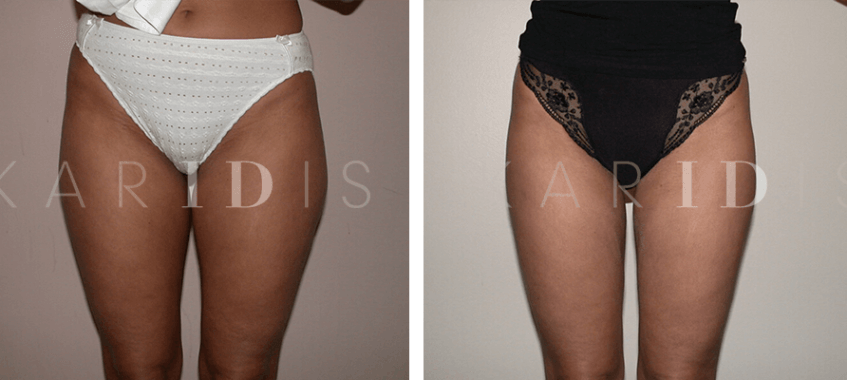 Thigh liposuction results