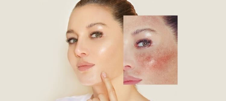 Treating rosacea as result of seasonal changes