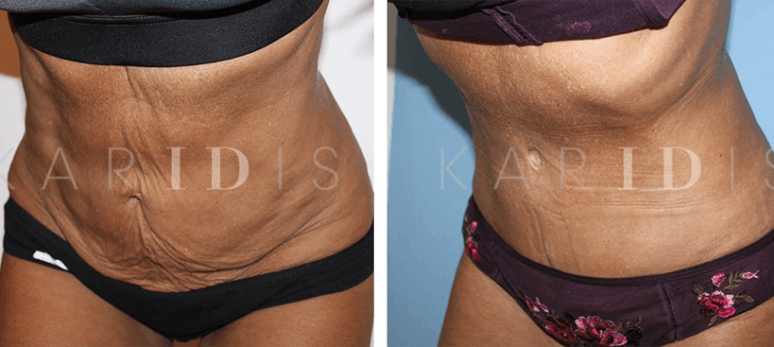 Abdominoplasty for skin laxity after lipo