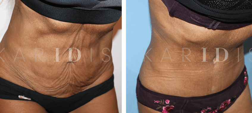 Tummy Tuck for skin laxity after lipo results