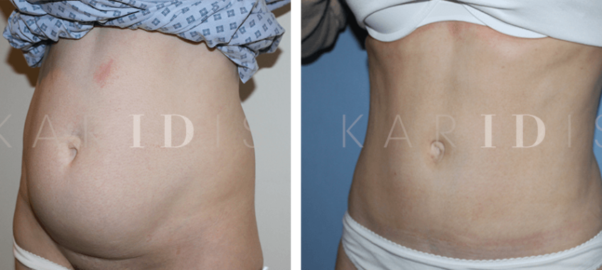 Tummy Tuck with abdominal muscle repair results