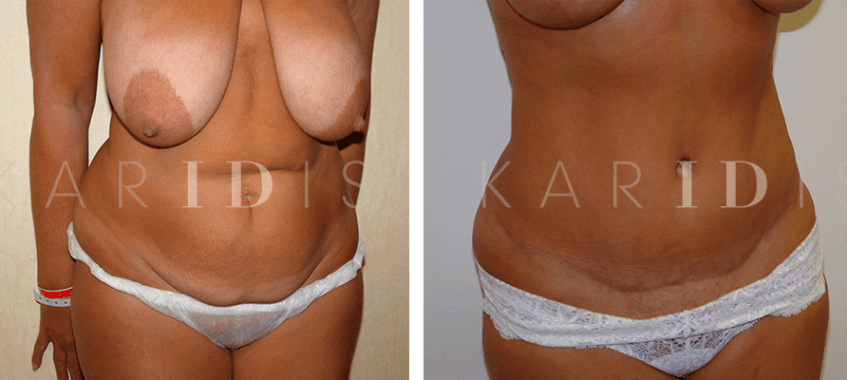 Tummy tuck and breast uplift results