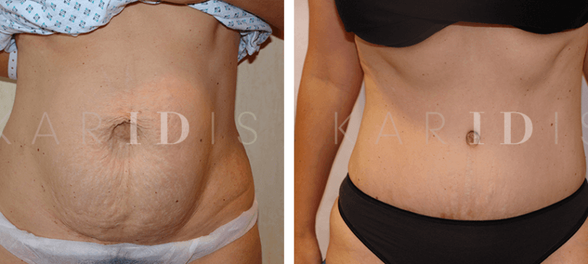 Tummy tuck with abdominal muscle tightening before and afters